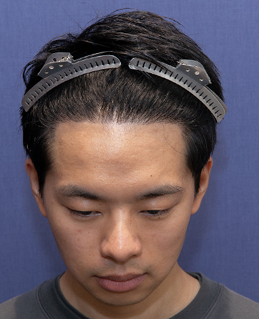 男性 S.S.さんの顔写真（術後1年）