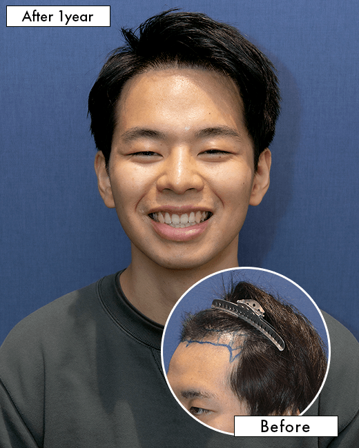 S.S.さんの上半身写真（術後1年）