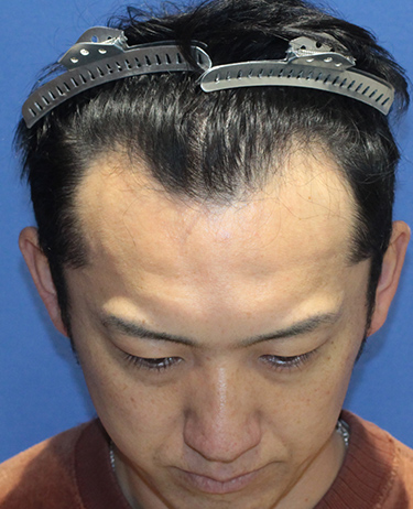 男性 S.Y.さんの顔写真（施術前）