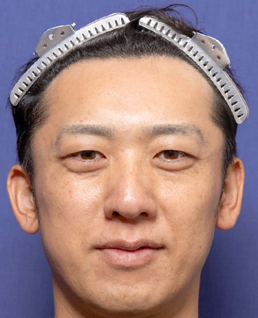 男性 S.Y.さんの顔写真（術後1年）