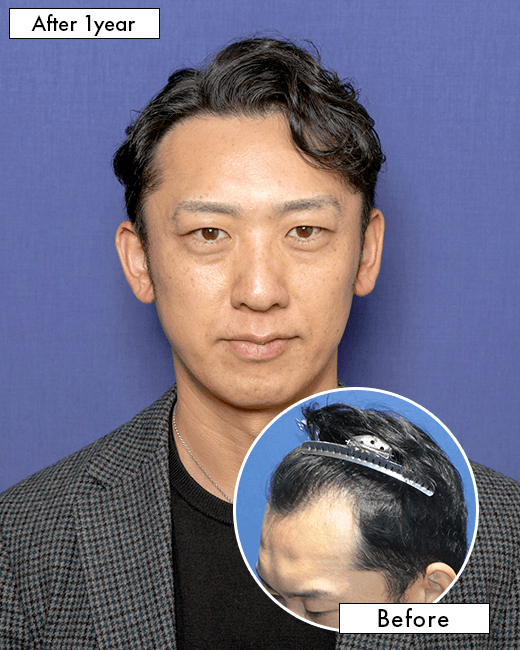 S.Y.さんの上半身写真（術後1年）