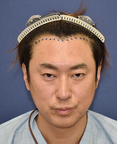 男性 M.M.さんの顔写真（施術前）