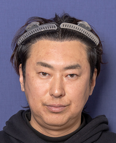 男性 M.M.さんの顔写真（術後1年）