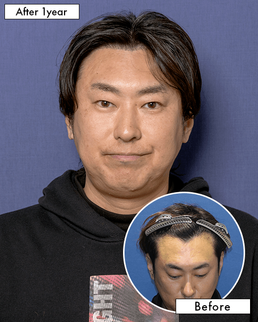 M.M.さんの上半身写真（術後1年）