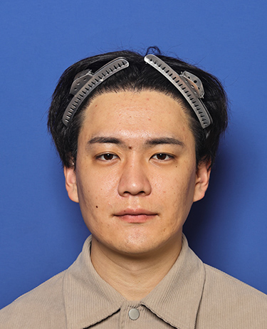 男性 T.S.さんの顔写真（術後1年）