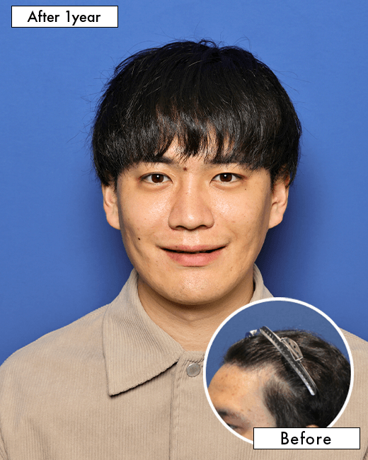 T.S.さんの上半身写真（術後6ヶ月）