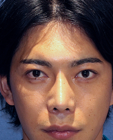 男性 F.R.さんの顔写真（施術前）