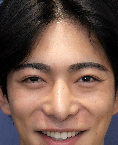 男性 F.R.さんの顔写真（術後1年）