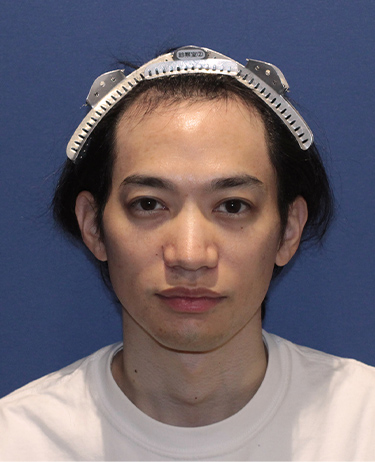 男性 K.H.さんの顔写真（施術前）