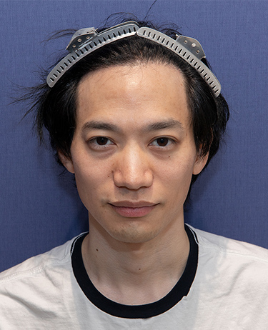 男性 K.H.さんの顔写真（術後1年）