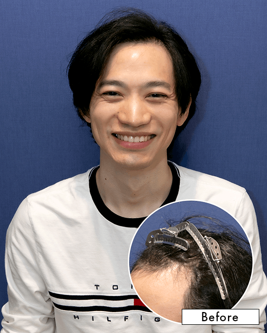 K.H.さんの上半身写真（術後1年）