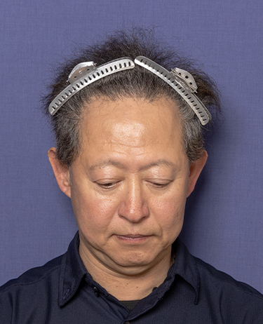 男性 S.M.さんの顔写真（術後1年）