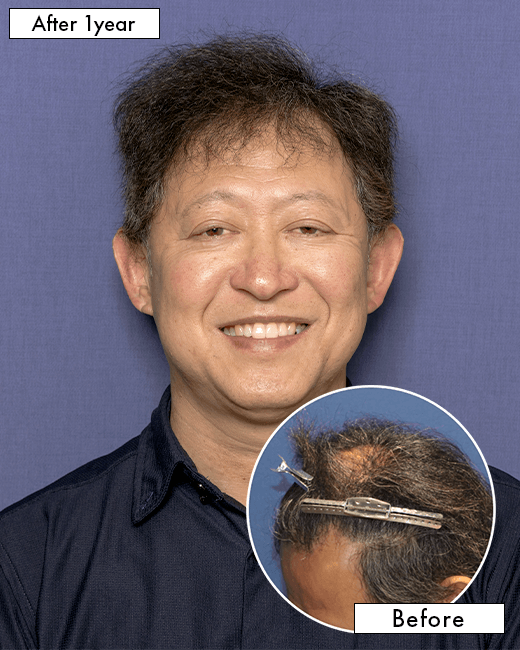 S.M.さんの上半身写真（術後1年）