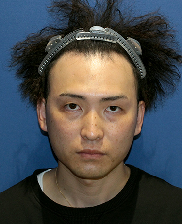 男性 N.Y.さんの顔写真（施術前）