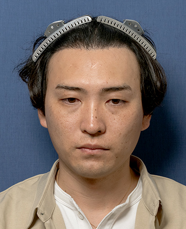 男性 N.Y.さんの顔写真（術後1年）