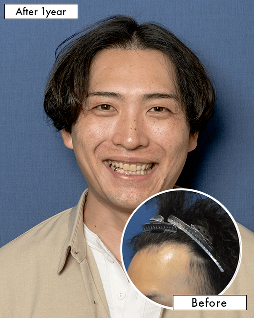 N.Y.さんの上半身写真（術後1年）