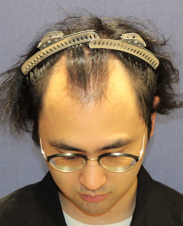 男性 S.D.さんの顔写真（施術前）