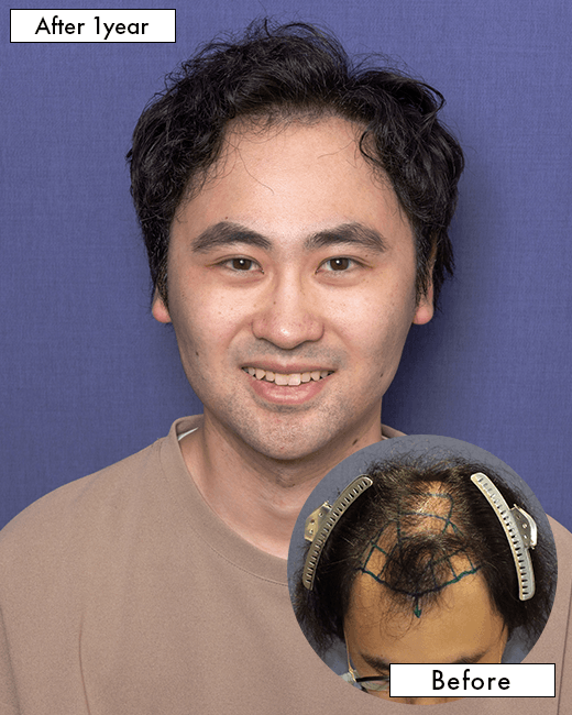 S.D.さんの上半身写真（術後1年）