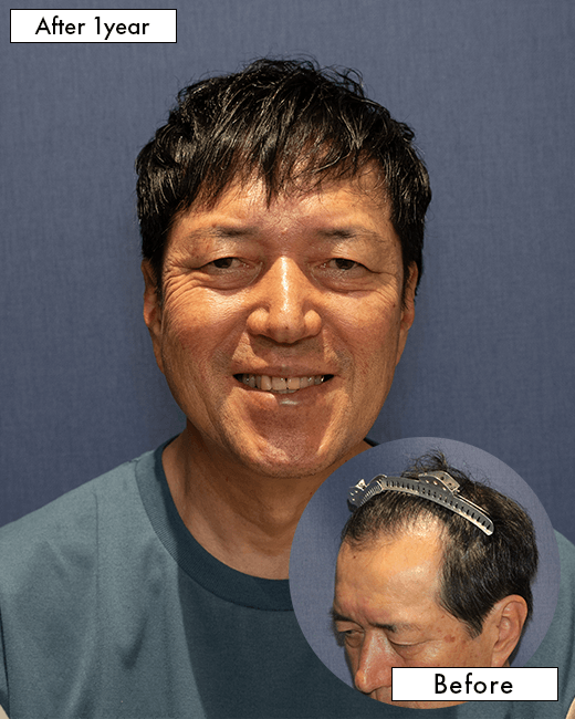 F.T.さんの上半身写真（術後1年）