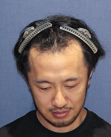 男性 N.H.さんの顔写真（施術前）
