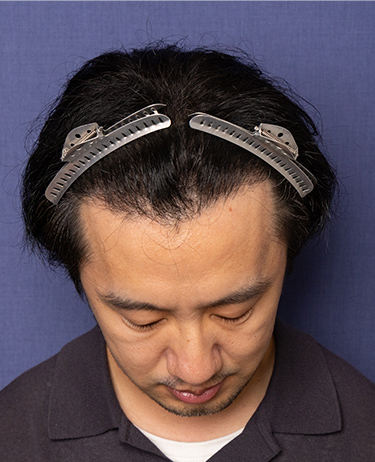 男性 N.H.さんの顔写真（術後1年）