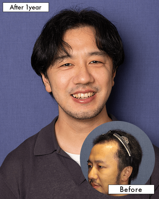 N.H.さんの上半身写真（術後1年）
