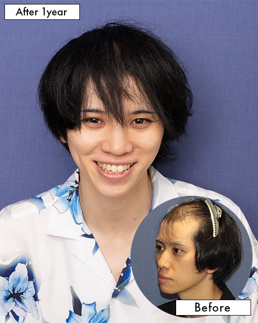 生え際・前頭部の自毛植毛症例（30代）：上半身写真（術後1年）