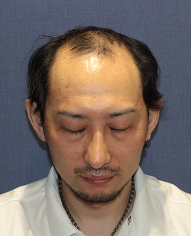生え際の自毛植毛症例（30代）：顔写真（施術前）