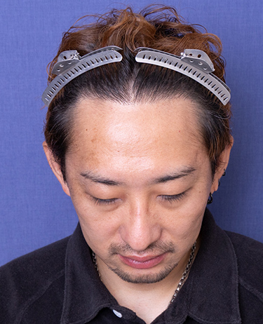 生え際の自毛植毛症例（30代）：顔写真（術後1年）