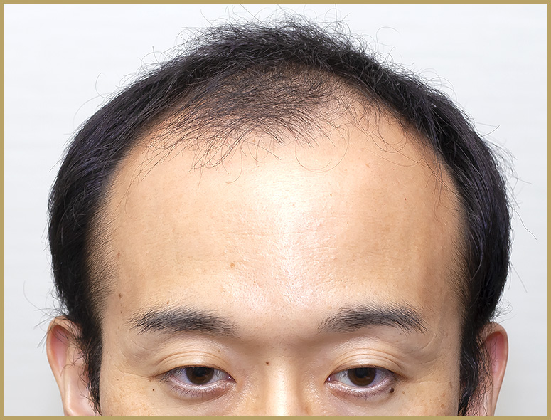 30代 男性 H.Kさんの頭部写真2（施術前）