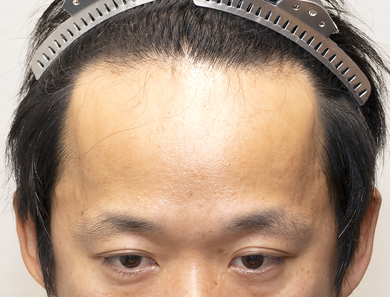 ホワイトベース二宮祥平さんの頭部写真2（施術前）