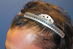 30代 男性 M.Y.さん  前頭部 頭頂部 自毛植毛（MIRAI法） 1,600株の症例（施術前）
