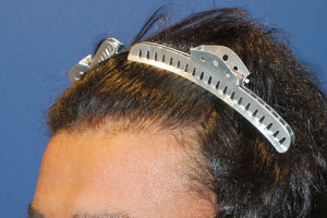 30代 男性 M.Y.さん  前頭部 頭頂部 自毛植毛（MIRAI法） 1,600株の症例（施術後）