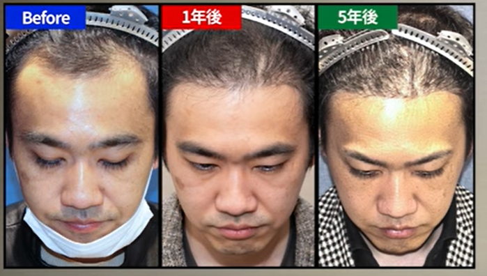 自毛植毛手術5年後のI.Sさん（30代・男性）自毛植毛手術（5年後の経過）