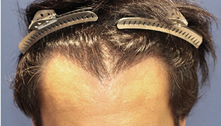 30代 男性 Y.M.さん 生え際・前頭部の自毛植毛（MIRAI法） 2,500株の症例（施術後）