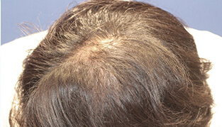 30代 男性 Y.M.さん 生え際・前頭部の自毛植毛（MIRAI法） 2,500株の症例（施術後）