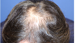 30代 男性 Y.M.さん 生え際・前頭部の自毛植毛（MIRAI法） 2,500株の症例（施術前）