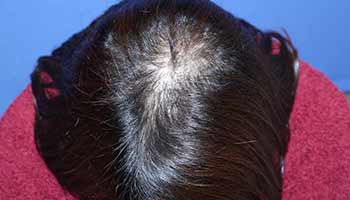 30代 女性 A.M.さん 前頭部・頭頂部の自毛植毛（MIRAI法） 2,000株の症例（施術後）