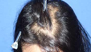 30代女性 びまん性脱毛症の症例（施術前）