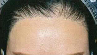 女性の自毛植毛症例写真 30代女性 1,100株 治療後