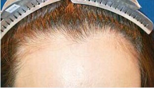 女性の自毛植毛症例写真 30代女性 1,100株 治療前