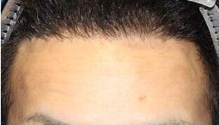 30代 男性 D.M.さん 生え際の自毛植毛（MIRAI法） 2,300株の症例（施術後）