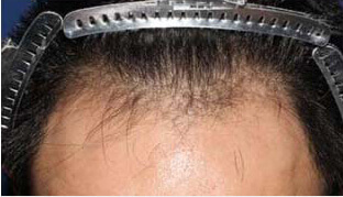 30代 男性 D.M.さん 生え際の自毛植毛（MIRAI法） 2,300株の症例（施術前）