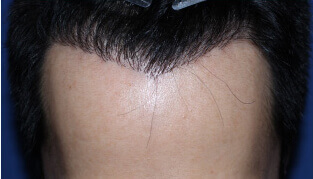 20代 男性 D.K.さん 生え際の自毛植毛（MIRAI法） 1,000株の症例（施術後）