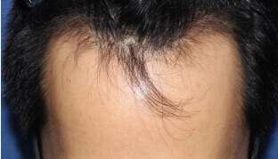 20代 男性 D.K.さん 生え際の自毛植毛（MIRAI法） 1,000株の症例（施術前）