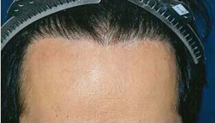 30代 男性 M.Y.さん 生え際の自毛植毛（MIRAI法） 1,500株｜自毛植毛の症例（施術後）