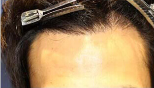 20代 男性 F.Y.さん 生え際の自毛植毛（NC-MIRAI法） 1,500株の症例（施術後）