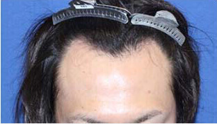 20代 男性 F.Y.さん 生え際の自毛植毛（NC-MIRAI法） 1,500株の症例（施術前）