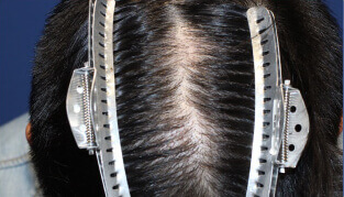 30代 男性 H.H.さん 分け目の自毛植毛（NC-MIRAI法） 750株の症例（施術後）