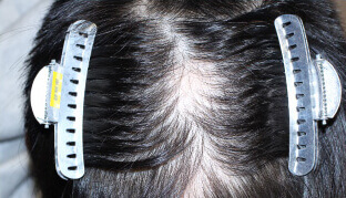30代 男性 H.H.さん 分け目の自毛植毛（NC-MIRAI法） 750株の症例（施術前）